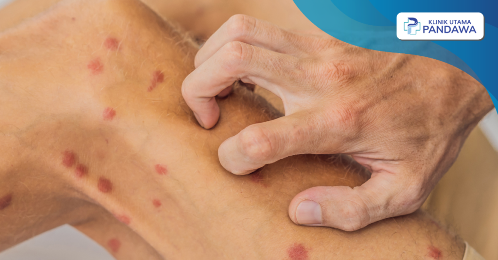 Licen Simpleks Kronik