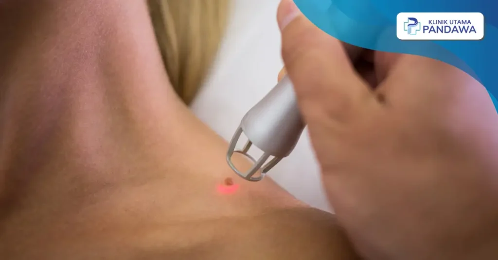 cara menghilangkan kutil di kulit