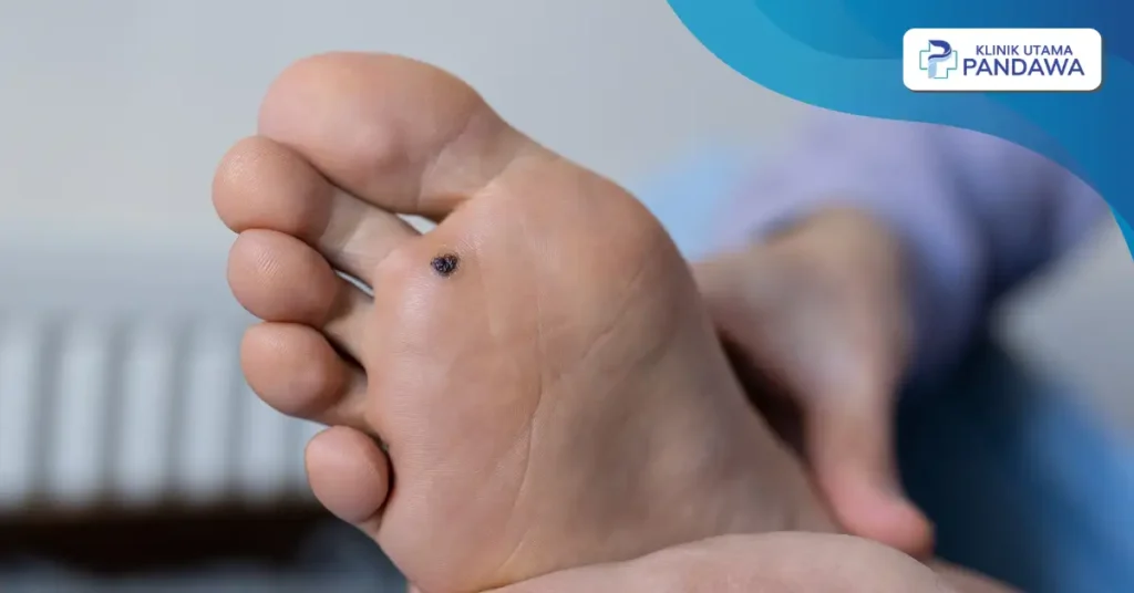 cara mengobati mata ikan di kaki