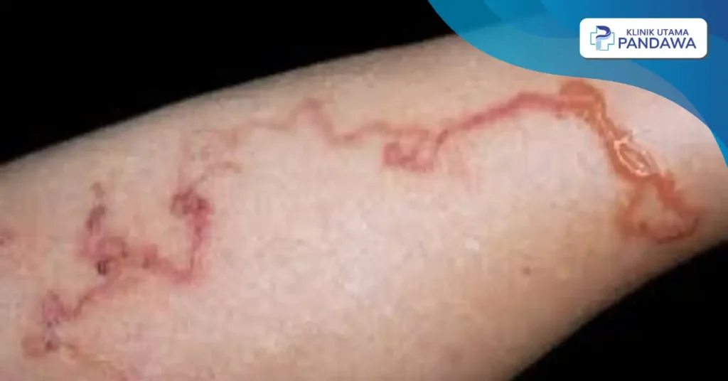 cutaneous larva migrans