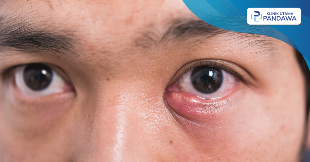 pengobatan blefaritis