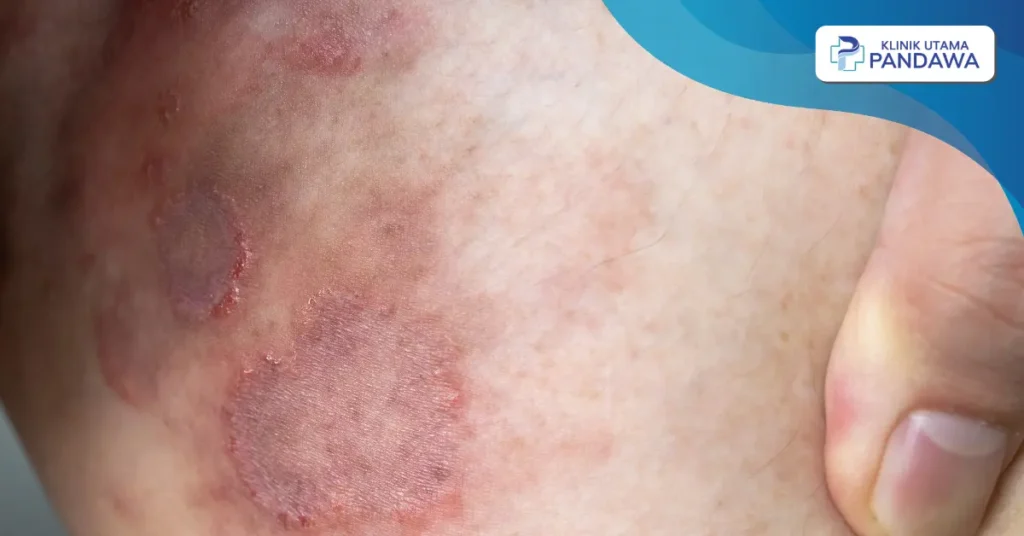 tinea inguinalis adalah