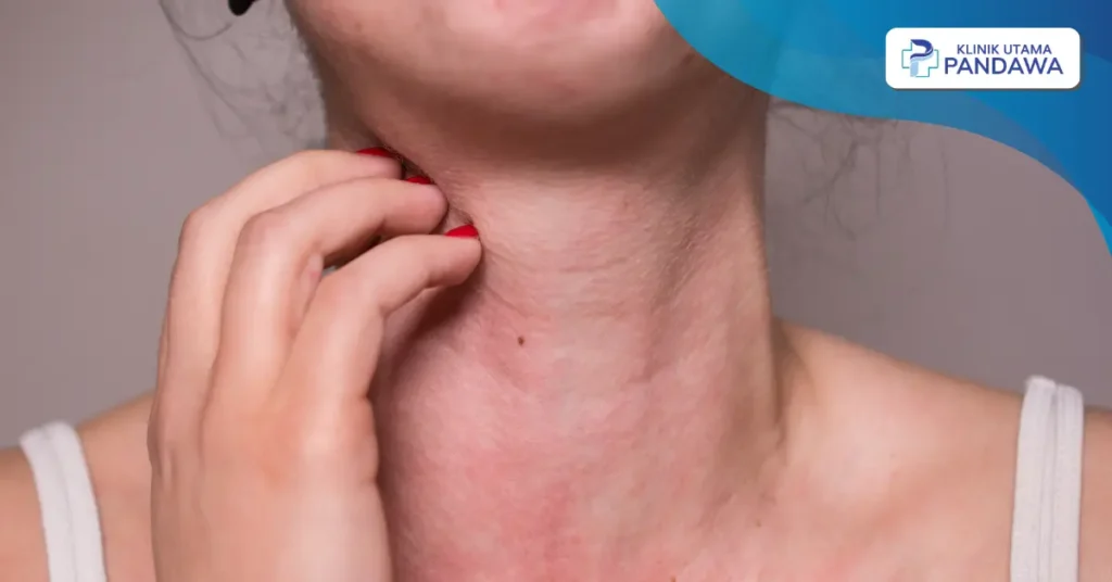 erupsi obat alergi