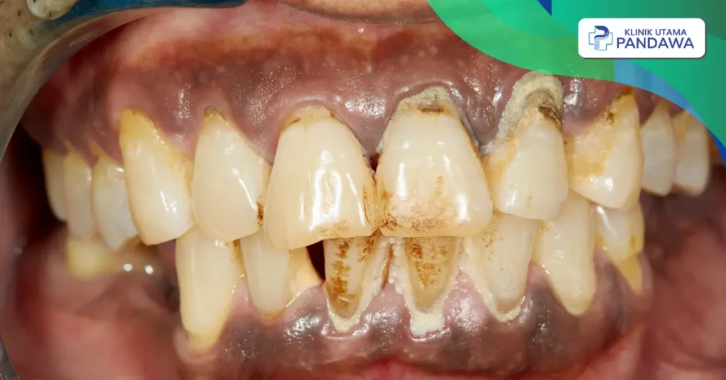 periodontitis kronis adalah