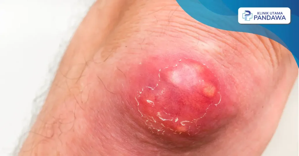 pioderma adalah