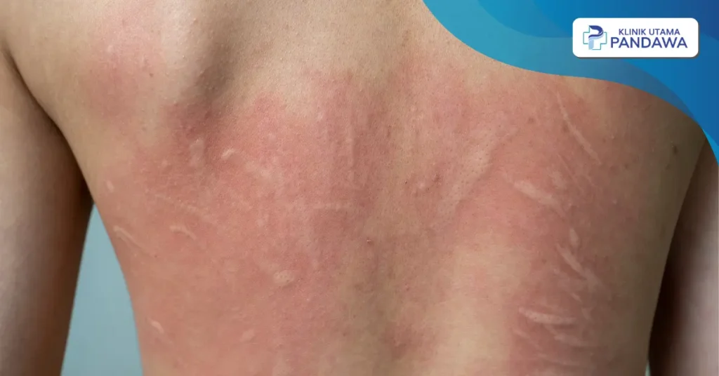 urtikaria kolinergik apakah bisa sembuh