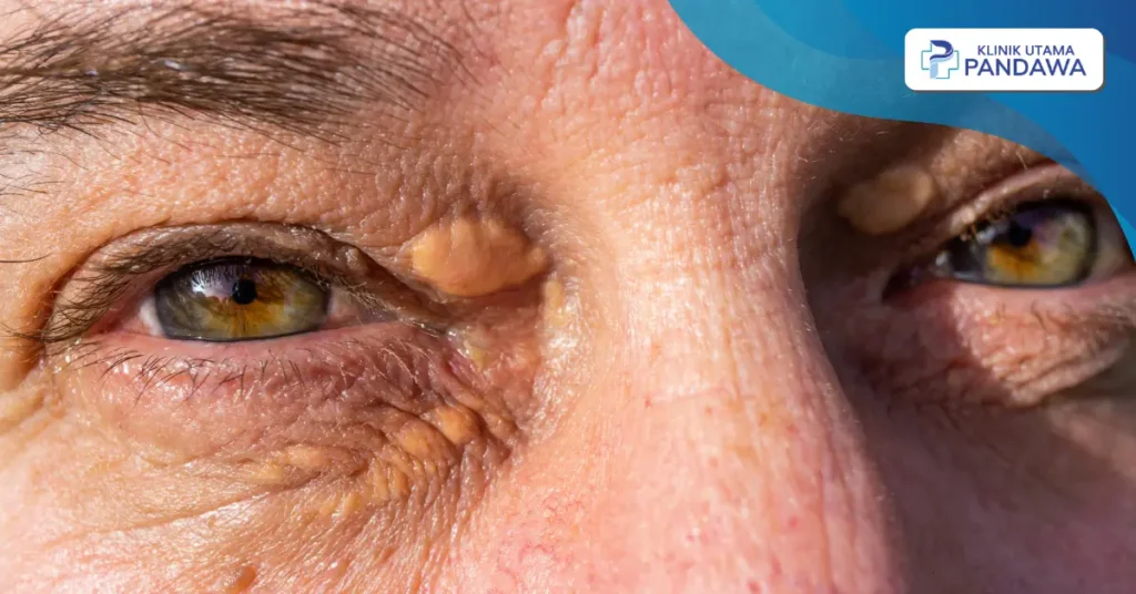cara menghilangkan xanthelasma