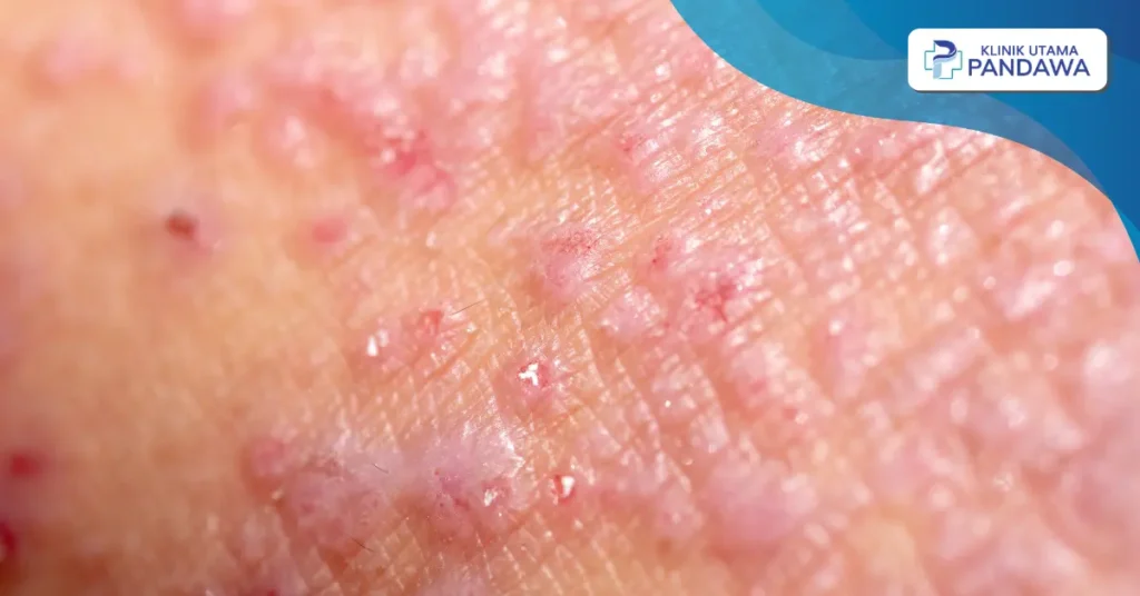 dermatitis asteatotik adalah